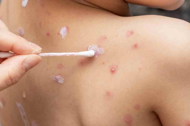 cara-mengobati-cacar-air-agar-cepat-kering-doktersehat