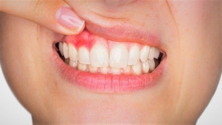 045486400_1568444089-Cara-Mengatasi-Gusi-Bengkak-by-sonriadentalclinic.co.uk